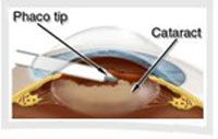 What Should One Expect After Cataract Surgery?