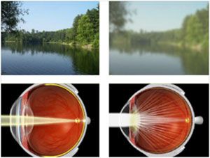 Cataract, formation and causes