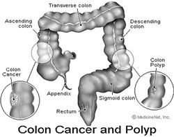 What you should know about colon cancer