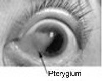 What is a Pterygium?