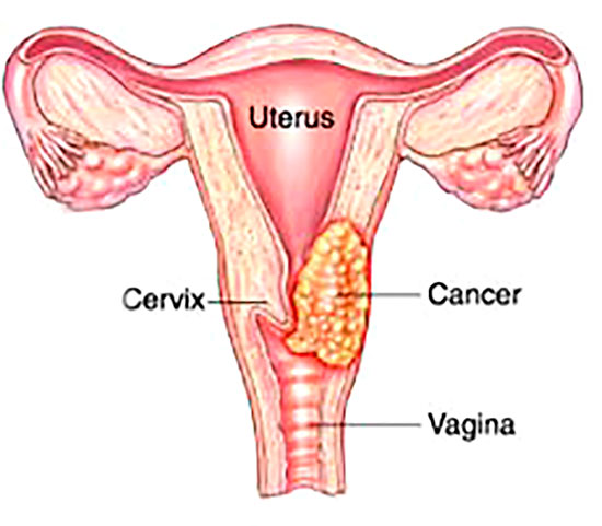 Cervical Cancer and HPV