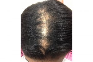 What steps can I take to prevent or slow hair loss?