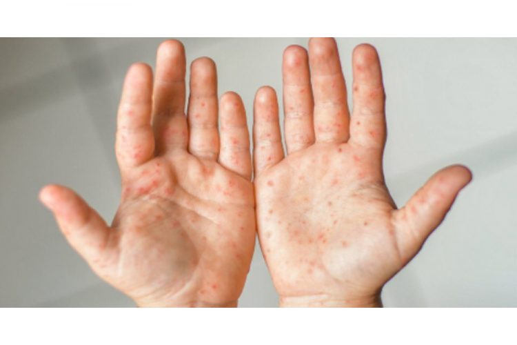 Cases of hand, foot and mouth disease confirmed in SVG schools – Ministry of Health